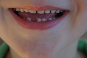 Was tun, wenn ein Zahn abgebrochen oder gebrochen ist
